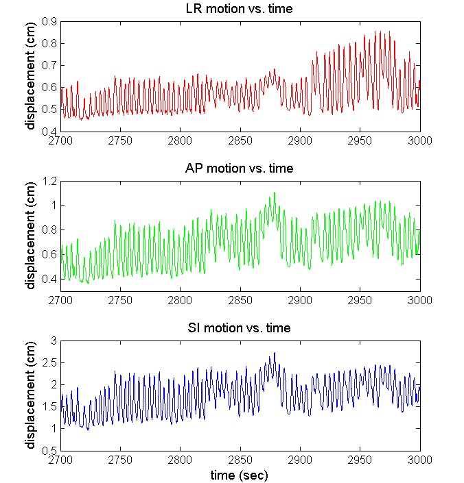 Fig 2. Observed variation in lung tumor motion with time in three dimensions from Cyberknife Synchrony data.