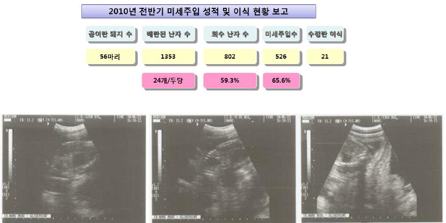 G-CSF 수정란 이식 후 임신 45일째 임신 진단 (초음파)