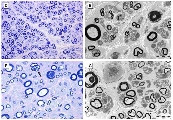 FC305 가족 환자의 distal sural nerve biopsy를 통해 관찰한 histopathology 데이터