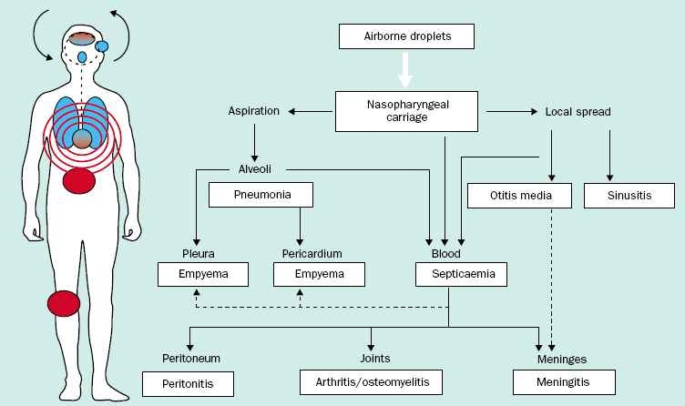 Invasive and non-invasive pneumococcal diseases [1]