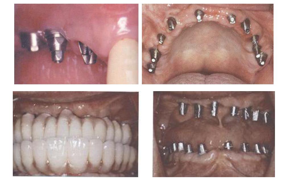 치과용 임플란트 상부구조물의 증례