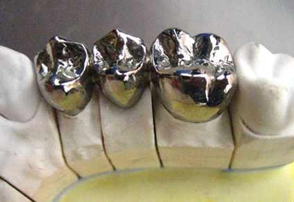치과주조용 준귀금속 합금으로 제작된 치관의 예