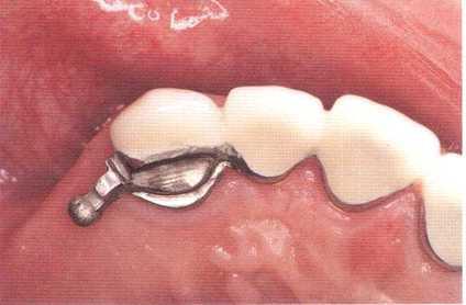 치과용 어태치먼트가 부착된 치관의 예
