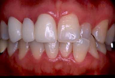 절삭가공용 치과도재 치관(#11-13)의 예