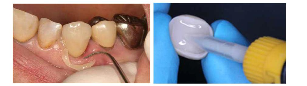치과용 레진계 시멘트의 사용 증례