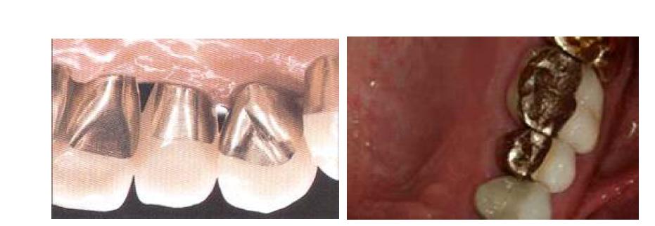 메탈세라믹용 귀금속 합금으로 제작된 치관의 예