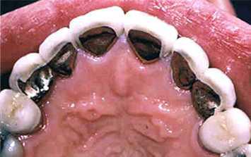 메탈세라믹용 비귀금속 합금으로 제작된 치관의 예
