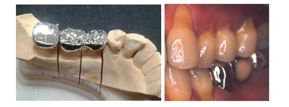 치과주조용 비귀금속 합금으로 제작된 치관의 예
