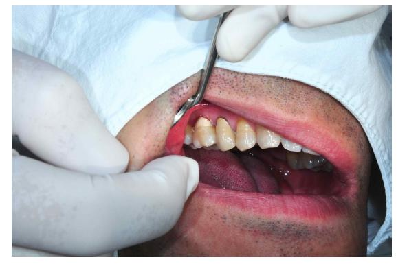 치과수복용 시멘트의 사용 증례