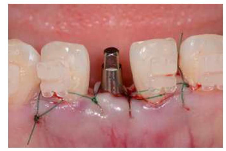 치과용 임플란트 시스템 식립 증례