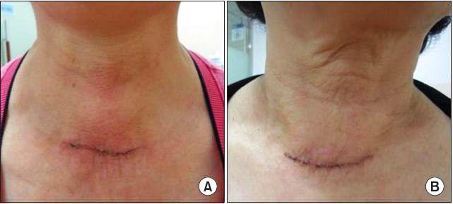 Skin changes on the cervical area after thyroid surgery.