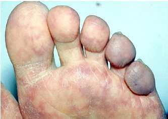 청색 발가락 증후군(blue toe syndrome)