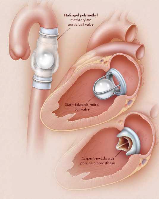 인공심장판막 진화의 3단계