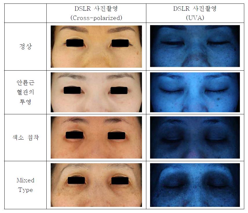 그림 8. 원인에 따른 다크서클 피험자의 DSLR 사진 자료
