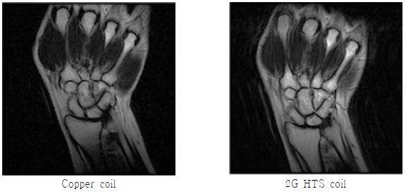 제작한 surface coil로 획득한 손목의 FSE 영상