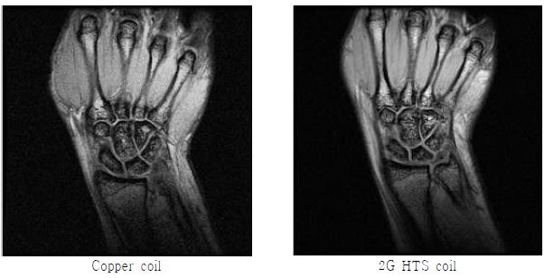 제작한 surface coil로 획득한 손목의 SPGR 영상