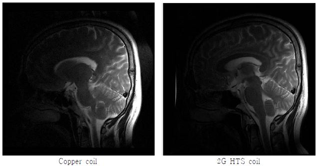 T2 FSE 머리 영상