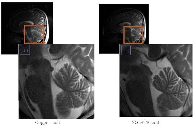 T2 FSE 머리 영상의 확대 영상