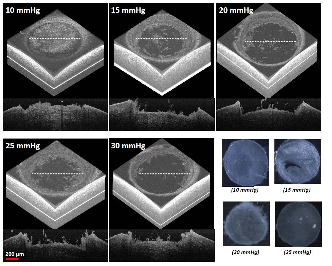 3D-OCT images of fs-laser flapped PDMS eyeball surface with changing the inner pressure