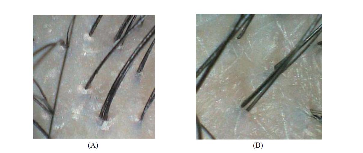 Microscope image of the scalp before(A) and after(B) treatment with effervescent tablet personal care product