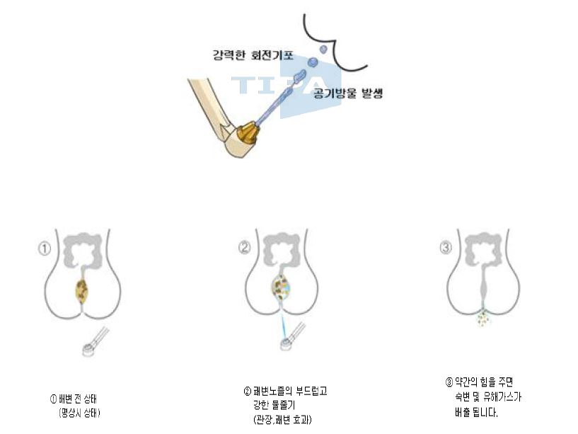 그림 2 _ 공기방울 생성 및 관장 효과