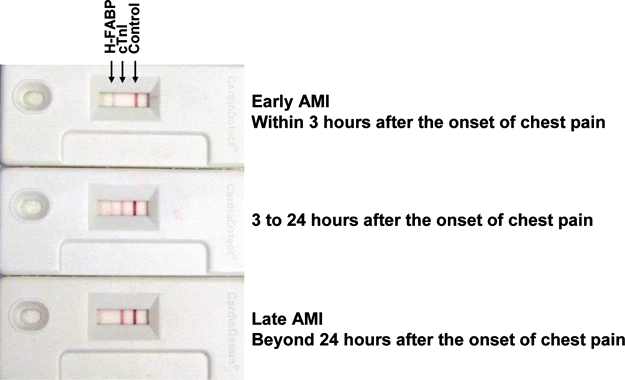 급성심근경색의 조기 진단을 위한 CardioDetectTM 의 해석