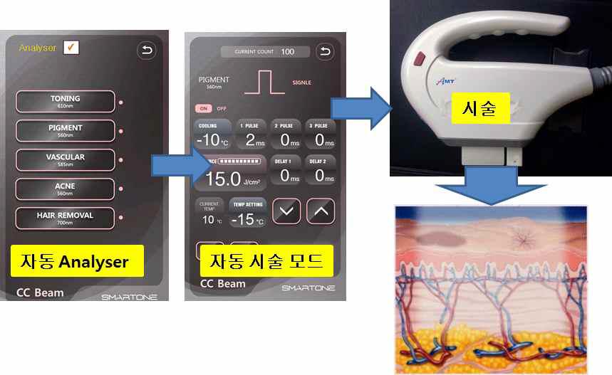 자동 파라메타 설정 및 시술