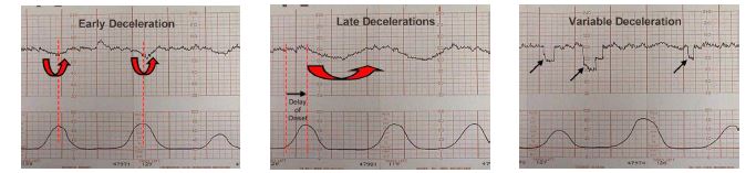 Early Deceleration, Late Deceleration, Variable Deceleration