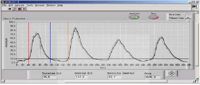 자궁수축 그래프의 분석 Fetal monitor chart 스캔 분석 방법