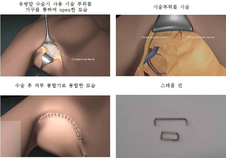 피부봉합기를 사용한 시술 예시