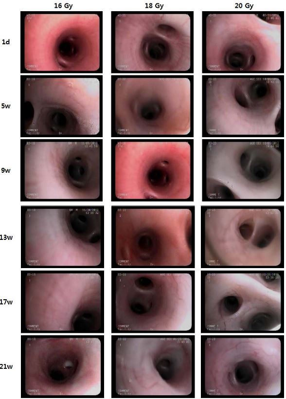 방사선 피폭 후 우측 폐엽의 기관지내시경 소견