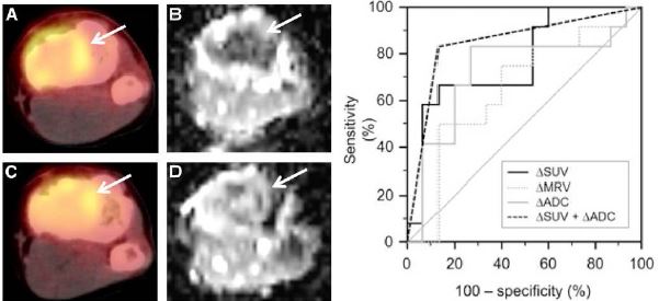 골육종의 항암치료 후 FDG PET과 DWI-MRI 영상의 변화(좌)와 SUV와 ADC 및 조합을 통한 항암반응 예측(우). 대사능 (SUV)과 확산계수 (ADC)를 각각 사용했을 때에 비해서 두 가지를 조합했을 때 정확도가 향상됨을 알 수 있다.