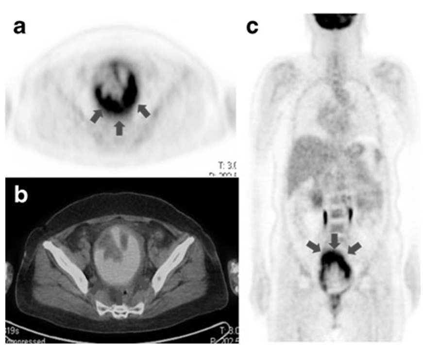 자궁의 악성종양 중 매우 드문 종류인 uterine epitholoid angiosarcoma의 FDG PET/CT 소견