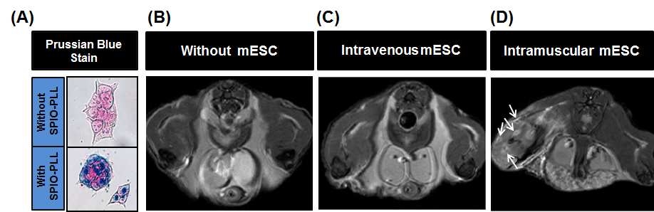 (A) Prussian blue stain of mouse ESC after incubation with SPIO (feridex? and PLL complex. Cells incubated with PLL for 12 hours. SPIO particles with dark blue color were accumulated in cells (400X). (B- D) T2- weighted MRI images of the buttock and thigh using 4.7T MR. (B) Male mice (8 weeks old) were anesthetized with ketamine and xylazine. Left inguinal lesion was dissected with animal microscopy (5X). Left common femoral artery was ligated with black silk (4.0) 1 cm apart and femoral artery was excised between ligation. Left buttock and thigh shows slight increased signal intensity because of mild ischemic inflammation. (C) SPIO- PLL labeled stem cells were injected to mouse by tail vein (2X106 cell). MR image shows no specific changes in the left ischemic buttock and thigh. SPIO- PLL labeled stem cells might not be inoculated into the ischemic muscle by intravenous injection. (D) Mice were injected in 3 places with SPIO- PLL labeled ESCs. Injections were applied as follows: 2X106 labeled cells were intramuscularly injected in the buttock, mid portion of the thigh, and in the calf area. MR image obtained 7 days after intramuscular injection of labeled mESCs with SPIO- PLL complex shows multiple tiny dark signals, which means SPIO- PLL labeled mESCs, surrounded by bright signal intensity (arrows). Swelling and diffuse increased signal intensity of the left buttock and thigh may be caused by cells injection.