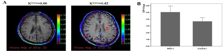 난치성 퇴행성 뇌질환 환자들에서 BBB impairment의 in vivo 증거들 (A; MR 영상, B; BBB index)