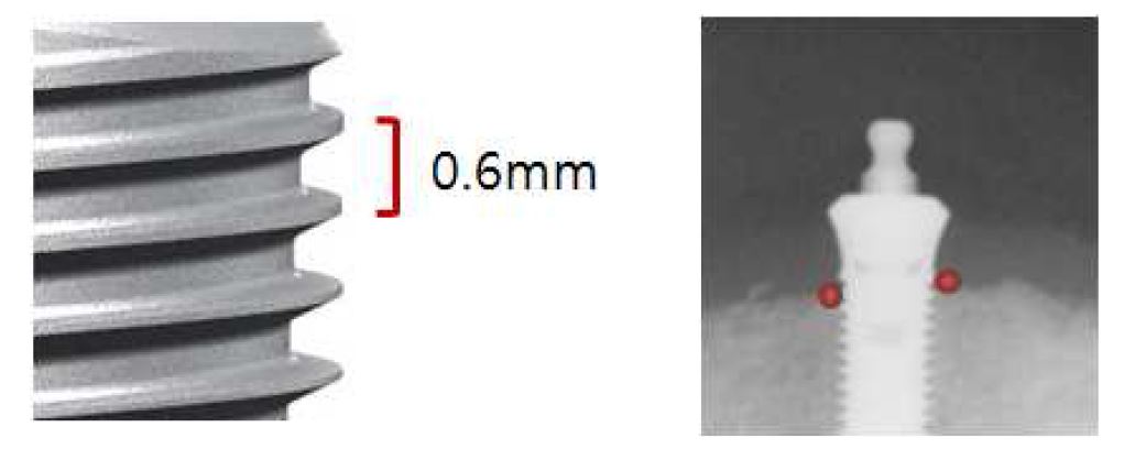그림 16. 치근단방사선 사진과 변연골 흡수량 측정