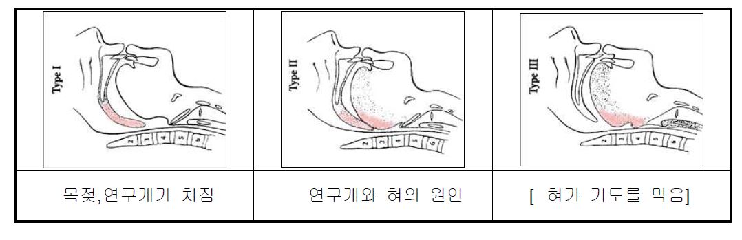 [코골이 수면무호흡증의 주요 원인]