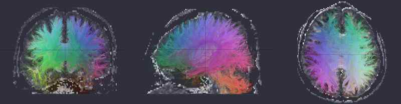 DoDTI를 이용한 신경경로 추적 예: coronal 방향 영상 (왼쪽), sagittal 방향 영상 (가운데), axial 방향 영상 (오른쪽)