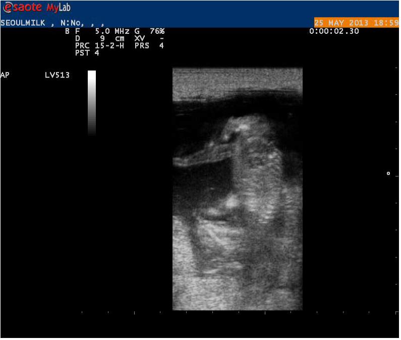 임신 50일령 태아 초음파 사진 모습