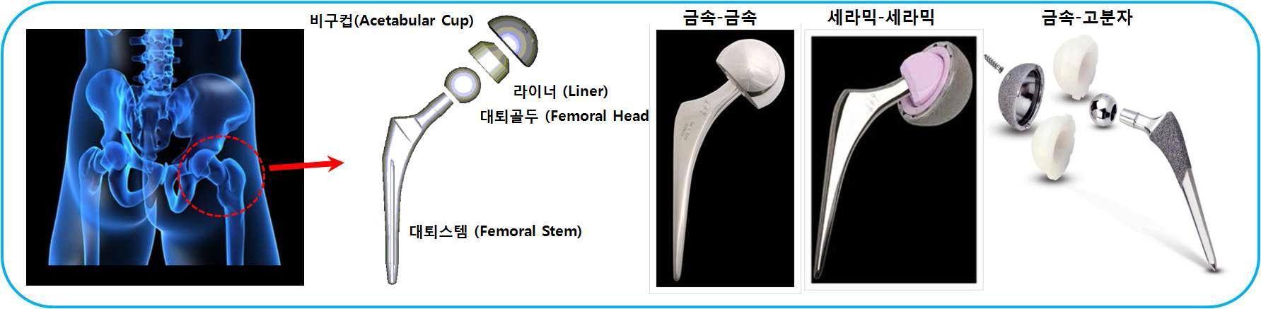 인공 고관절 구성 및 사용되는 관절면 재료들