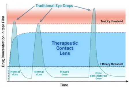 콘택트렌즈를 이용한 약물 전달 효과
