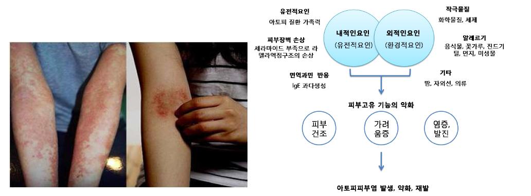 아토피발병 원인