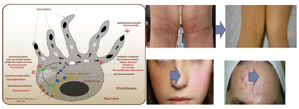피부내 멜라닌세포 활성 차단에 의한 피부 멜라닌 과다침착 개선.