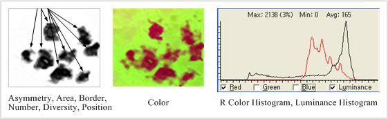 그레이 멜라닌 검출 영상에서 Asymmetry, Area, Border, Number, Diversity, Position 결정 및 컬러 멜라닌 검출 영상에서 컬러 히스토그램 분석을 통한 색상 결정