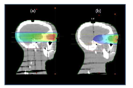 MeV(a)와 keV(b)를 이용하여 eye treatment에 대한 sagittal dose distribution