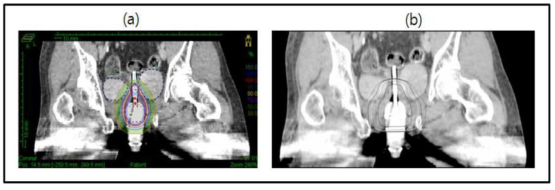 자궁경부암 환자에 대한 coronal 영상.