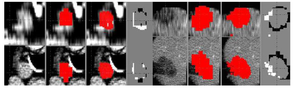 1) Liver CT only, 2) Liver PET에서 종양볼륨추출 3) Liver PET-CT에서 종양볼륨추출 4) Liver PET-CT 종양볼륨에서 Liver PET 종양볼륨 감산.