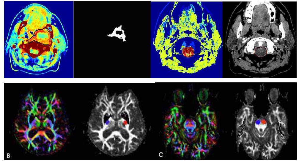 Region of Interest (ROI). In infarct region, ROI was placed in the high signal area on DWI and second ROI wasplaced in the matched-contralateral area. In distal to tumor region, ROI was placed in the projection fiber at the posterior limb of internal capsule and pons on color-coded DTI. Red circle is ipsilateral ROI and blue circle is contralateral ROI.