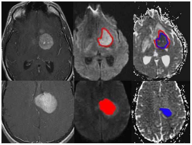 Diffusion tensor imaging을 활용한 종양볼륨분석