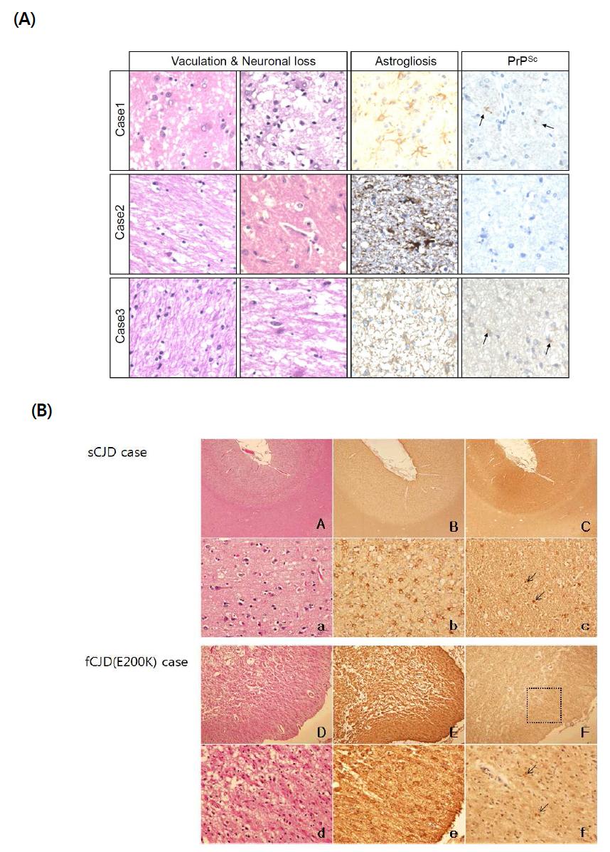 Pathological characterization of brains of sCJD, fCJD patients.